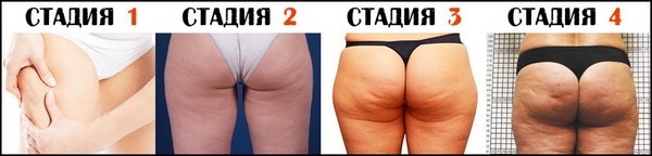 Стадии целлюлита